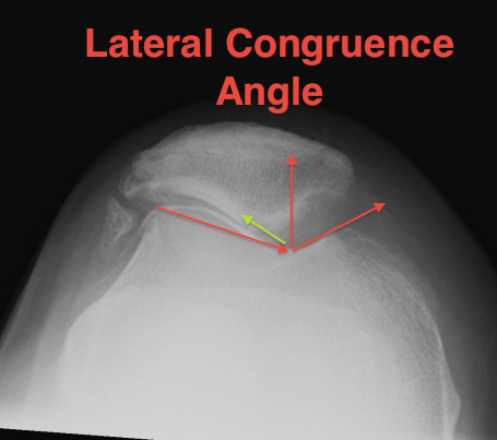Patella Lateral Congruence Angle
